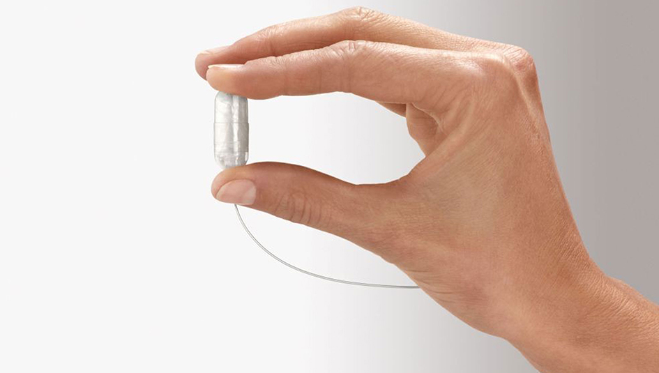 Photo of Swallowing a Balloon for Weight Loss?