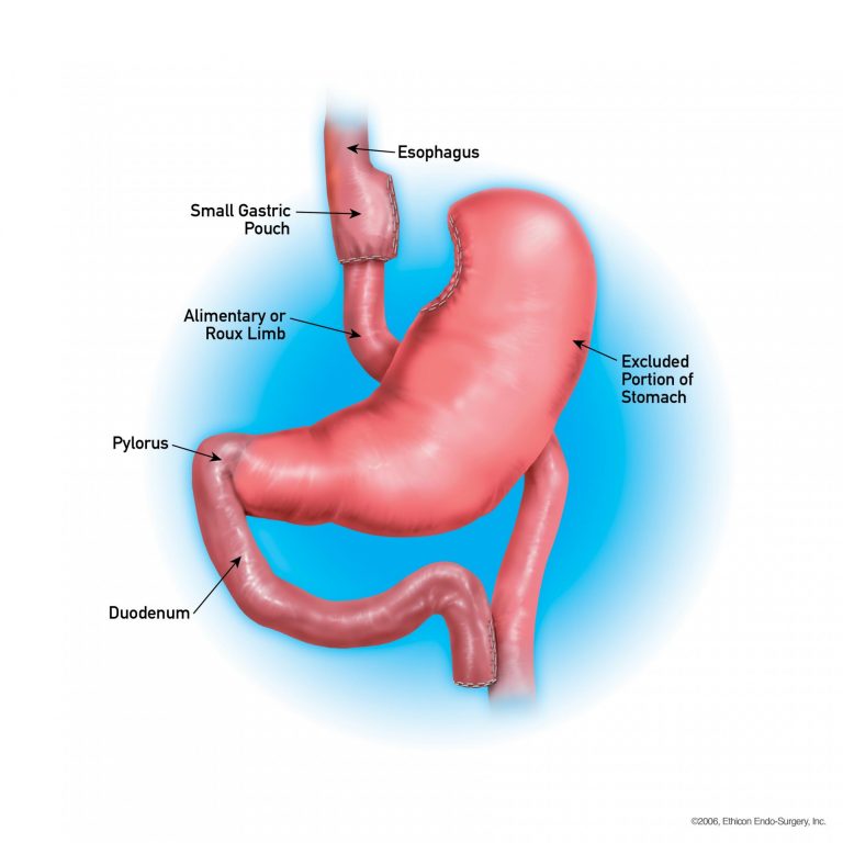 Bariatric Surgery Is A Critical Tool For Type Diabetes Treatment