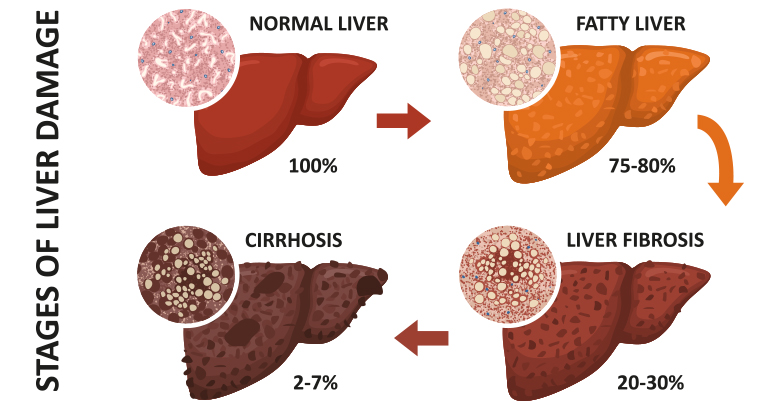 Investigational NASH Diagnostic Tool Could be a Game-Changer for the ...